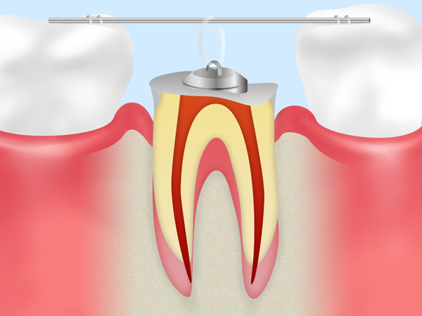 できるだけ抜歯をしない虫歯治療