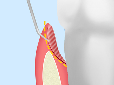 歯周ポケットそうは術
