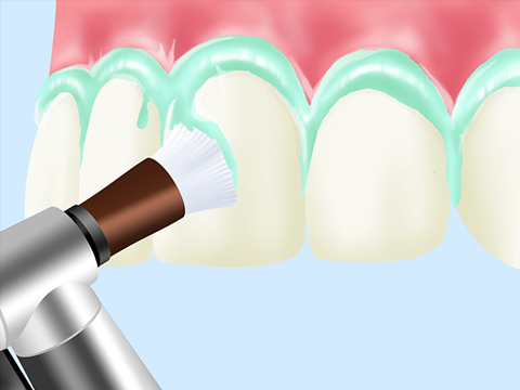 PMTC（歯のクリーニング）